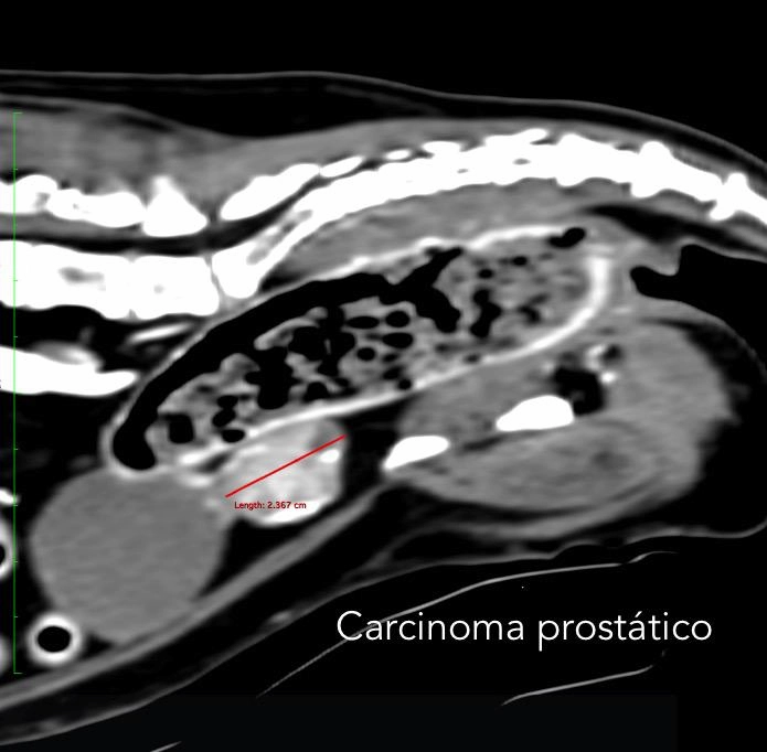 carcinoma prostatico