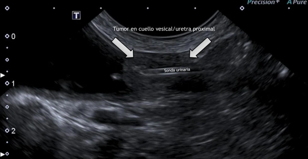 tumor cuello