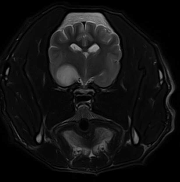 resonancia magnetica neurologia-glioma